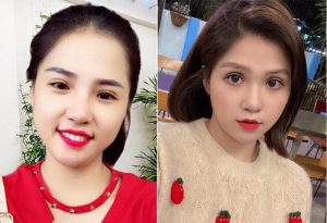 cắt mí