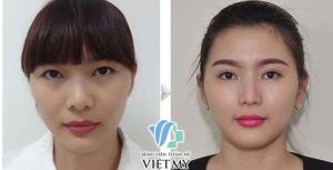 nhấn mí mở tròng
