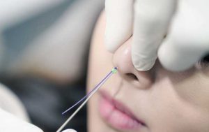 Nâng mũi bằng chỉ hiko