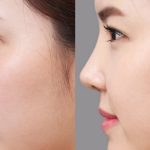 nâng mũi ở bác sĩ phùng