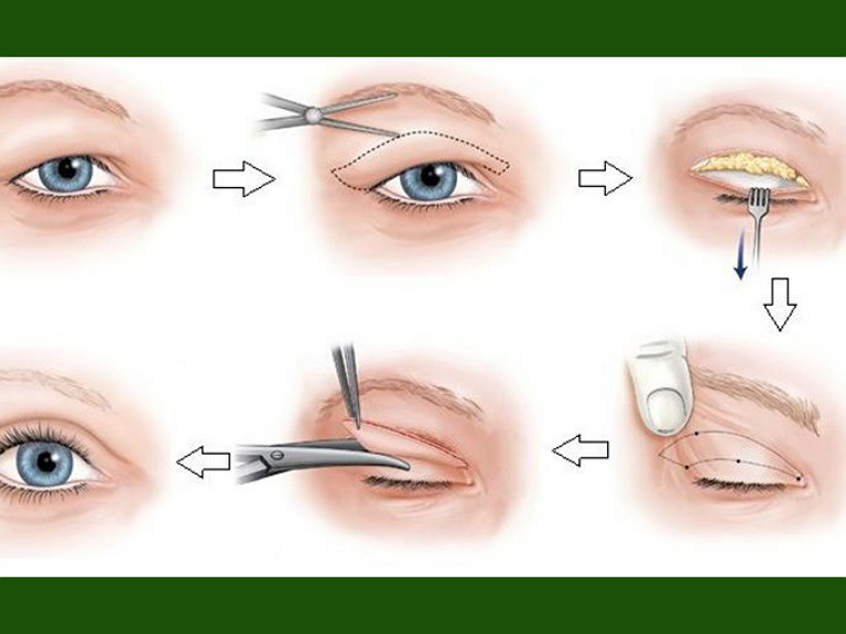 phẫu thuật cắt mắt