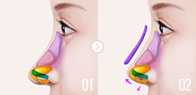 phương pháp nâng mũi A Shape
