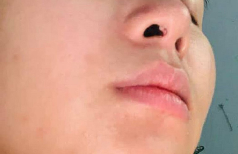 Nâng mũi bị nổi cục trong lỗ mũi