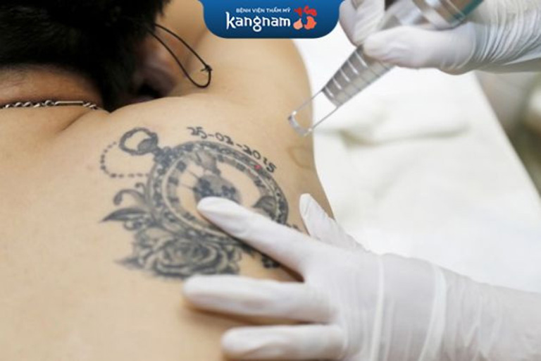 dịch vụ xóa tattoo tphcm