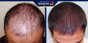 cấy tóc tại tphcm