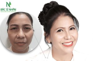 địa chỉ cắt mí mắt uy tín tại đà nẵng