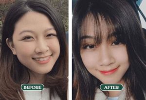 cắt mí mắt