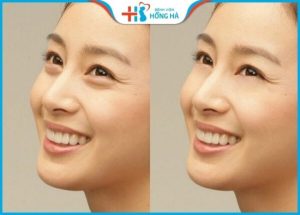 địa chỉ lấy mỡ bọng mắt tại hà nội