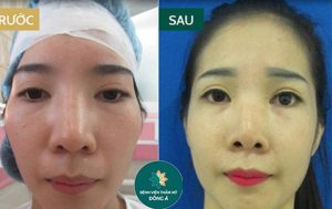 địa chỉ phẫu thuật hạ gò má tại tphcm
