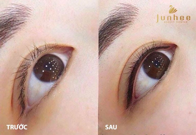 cắt mí bị trợn