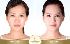 địa chỉ tiêm filler uy tín ở Đà Nẵ ng