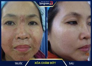 địa chỉ xóa chàm bớt bẩm sinh ở tphcm