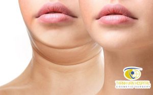 địa chỉ xóa nọng cằm tại tphcm