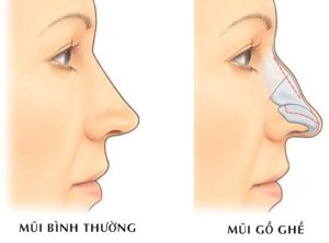 mài gồ xương mũi