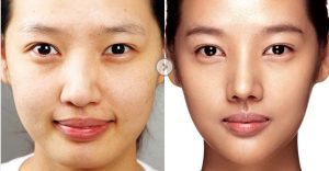 nâng mũi bị lệch phải làm sao