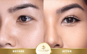 cải thiện mắt một mí