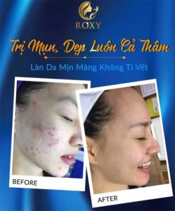 spa trị mụn tại quận 2