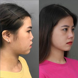 Địa chỉ sửa mũi hỏng tphcm