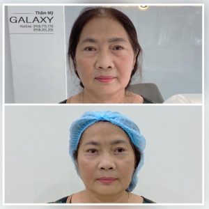 địa chỉ lấy mỡ bọng mắt tphcm