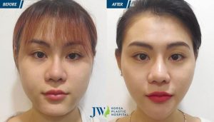 địa chỉ hút mỡ mặt cằm má tại TPHCM