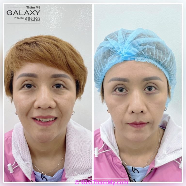 nâng cung chân mày tphcm