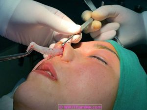 Nâng mũi bị tử vong: Những nguy cơ khi phẫu thuật cần phải biết