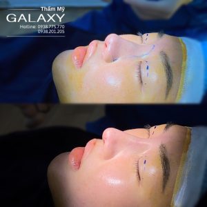 nâng mũi ở đâu đẹp ở TPHCM