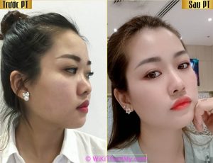 Thẩm mỹ viện Mài Gồ Xương Mũi tại TPHCM
