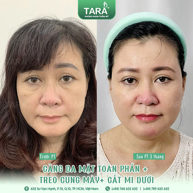 Căng da mặt TPHCM tại Tara beauty Clinic
