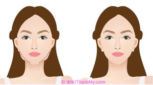 Hút mỡ mặt là gì? Ưu nhược điểm của hút mỡ mặt