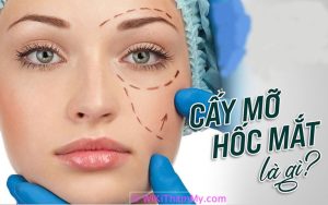 Cấy mỡ hốc mắt là gì? Có an toàn không? Chi phí bao nhiêu?
