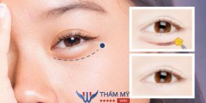 Cắt mí dưới có để lại sẹo không? Cách để tránh sẹo sau phẫu thuật