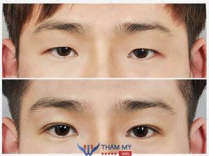 Cắt mí nam khác gì so với cắt mí nữ? Quy trình, chi phí cắt mí nam
