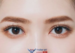 Cắt, Nhấn mí mắt có được vĩnh viễn không? Được bao lâu?