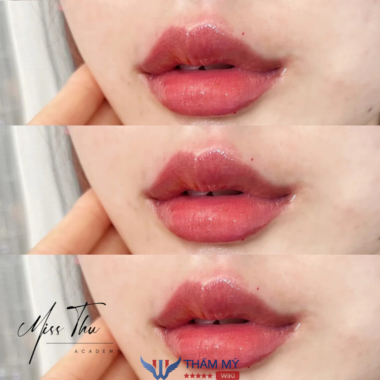 Viện Thẩm Mỹ MISS THU tiêm filler ở Đồng Tháp 