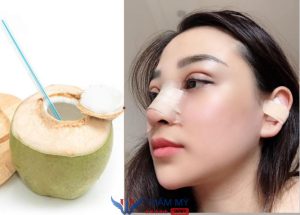 Mới nâng mũi có uống nước dừa được không? Giải đáp
