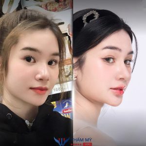 Nâng mũi 3 – 5 triệu: Đừng vội tin vào quảng cáo nâng mũi giá rẻ