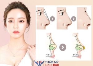 Nâng mũi bán cấu trúc dựng trụ là gì? Ưu – Nhược điểm, Chi phí