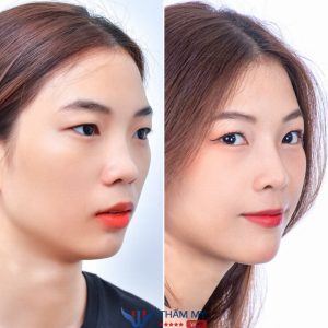 Nâng mũi có bị kéo mắt không? Bác sĩ giải đáp