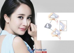 Nâng Mũi Pureform là gì? Ưu nhược điểm và chi phí thực hiện