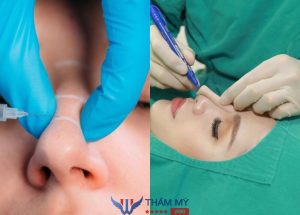 Nên tiêm filler hay nâng mũi? Phương pháp nào tốt hơn?