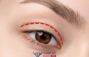 Nhấn mí chỉ Collagen: Ưu nhược điểm và chi phí thực hiện