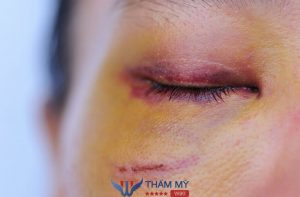 Nhấn mí mắt bị bầm tím: Nguyên nhân và hướng xử lý đúng