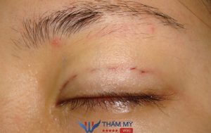 Nhấn mí mắt có đau không? Bao lâu thì lành? [Giải đáp]