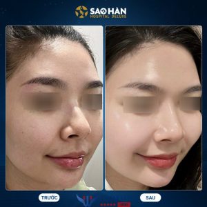 Sao Hàn Deluxe: Thẩm mỹ viện căng chỉ, truyền tế bào gốc uy tín chất lượng