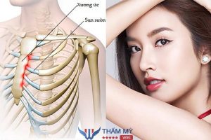 Sụn sườn nâng mũi lấy ở đâu? Có đau không? Để lại sẹo không?