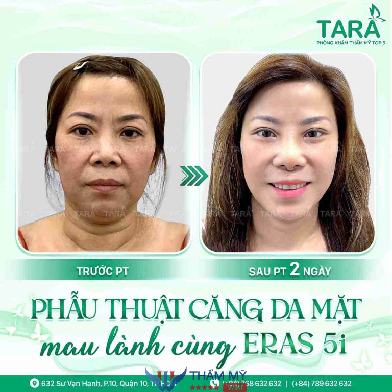 Bác sĩ Trang căng da trẻ hóa gương mặt