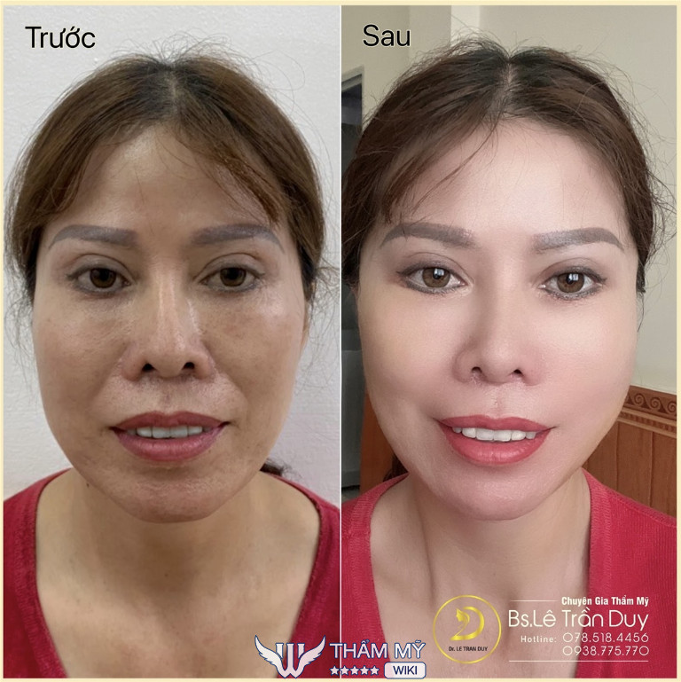 Căng da mặt tại BS Lê Trần Duy