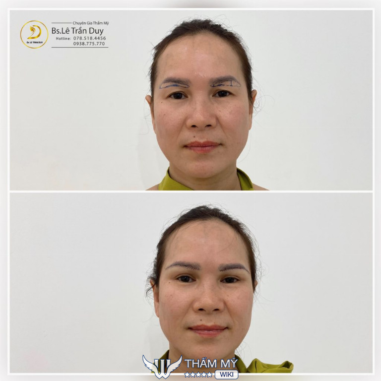 Treo chân mày tại BS Lê Trần Duy