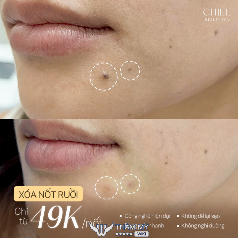CHIEE Beauty Spa - Địa chỉ xóa nốt ruồi ở Thủ Đức
